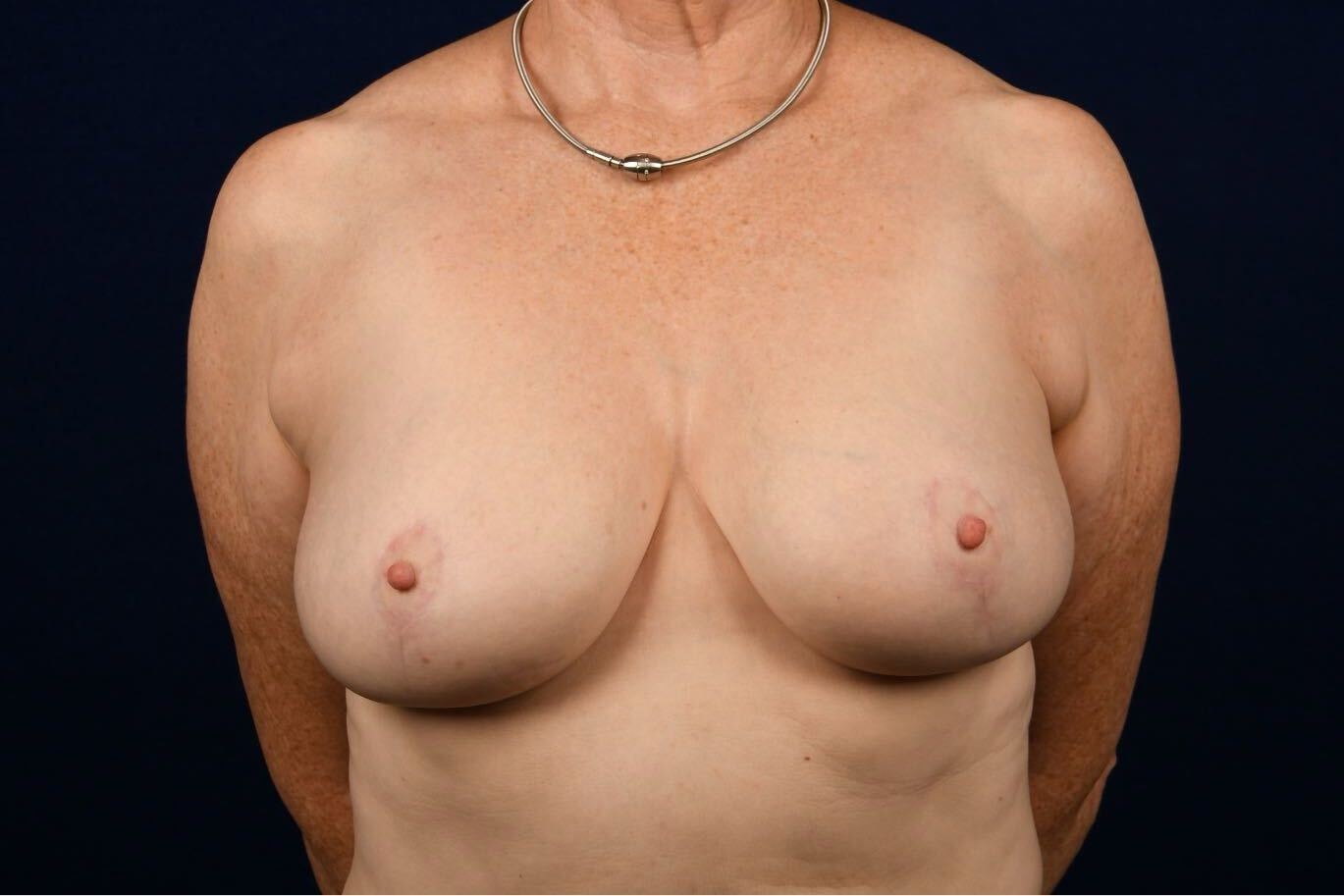 Breast Lift Reduction Before & After