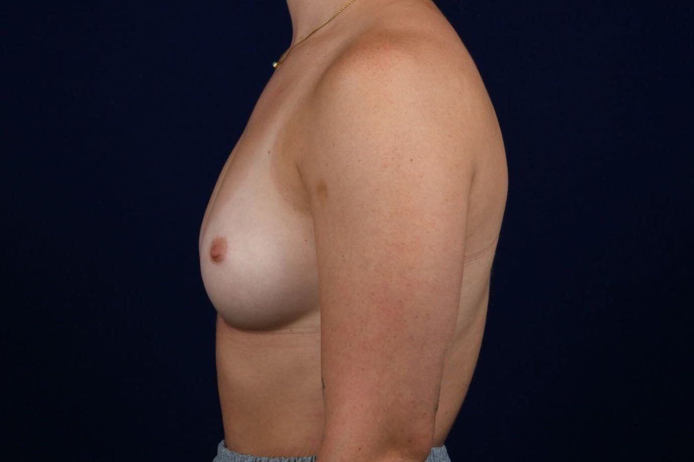 Breast Augmentation Before & After